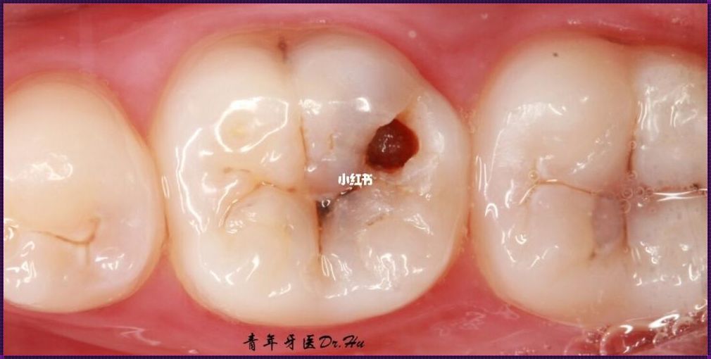 育儿心得：牙医不建议小孩补牙，怎么办？