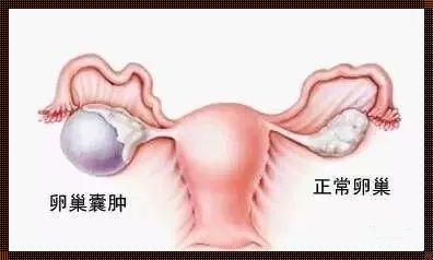 右侧卵巢囊肿生理性治疗的探索与实践