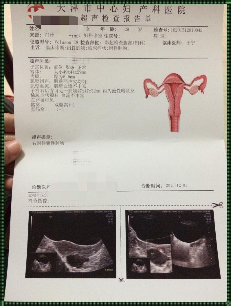 阴超可以看卵巢囊肿吗——惊现卵巢囊肿的检测之谜